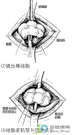 横结肠造瘘术