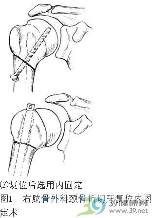 肱骨外科颈骨折切开复位内固定术手术步骤详解