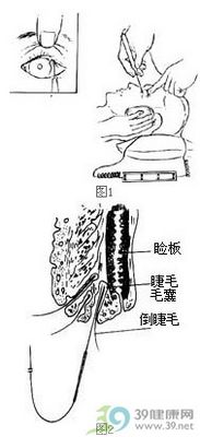 倒睫电解(冷冻)术步骤_手术查询_39健康网