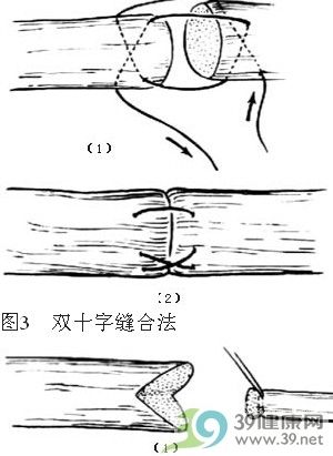 肌腱缝合术