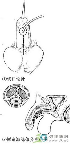 前尿道延伸阴茎伸直位固定法步骤_手术查询_39健康网