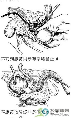 耻骨上经膀胱前列腺切除术步骤_手术查询_39健康网