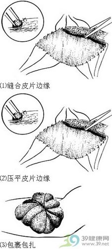 肉芽组织镜下观手绘图