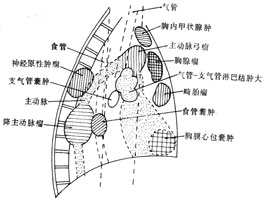 原发性纵隔肿瘤