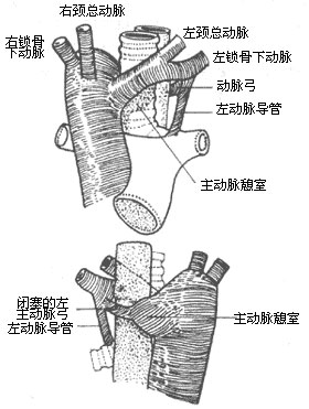 先天性主动脉弓畸形如何预防