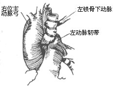 先天性主动脉弓畸形如何预防