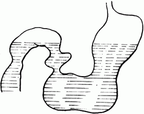 胃与十二指导肠的双液平面