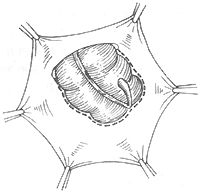 腹股溝滑動(dòng)性疝