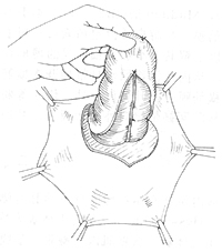 腹股溝滑動(dòng)性疝