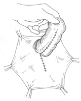 腹股溝滑動(dòng)性疝