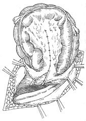 腹股溝滑動(dòng)性疝