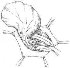 腹股溝滑動(dòng)性疝