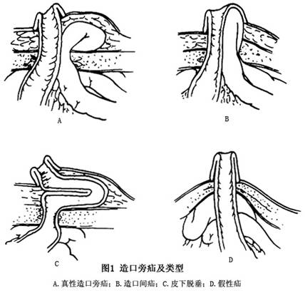 造口旁疝的病因