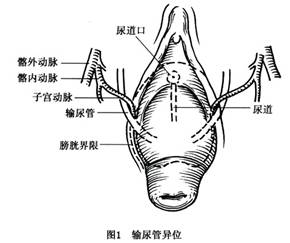 子宫脱垂有哪些症状表现及如何诊断?