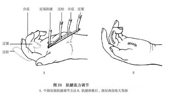 移植肌腱张力调整 移植肌腱张力过大,手指