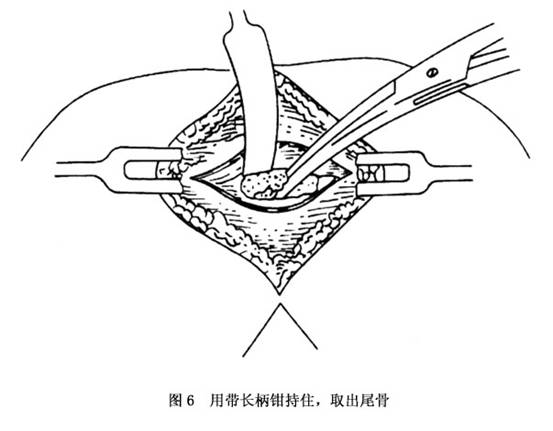 尾骨骨折与脱位如何治疗