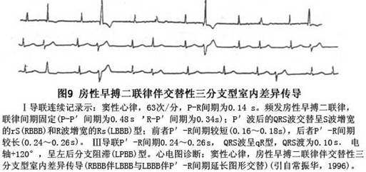 左心房收缩不同步性的影响因素与急性脑梗死发病的相关性