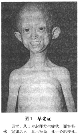 小儿早老症的症状_疾病查询_阿里医药网