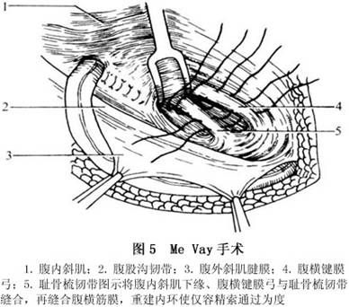 成人腹股沟斜疝