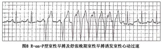 室性期前收缩