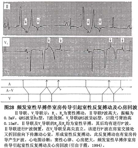 (21)室性期前收缩伴逆行性室房传导及反复搏动:室性期前收缩伴逆行