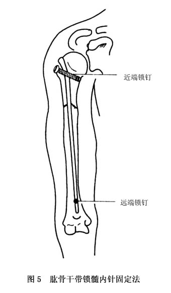 肱骨干骨折应该如何治疗?