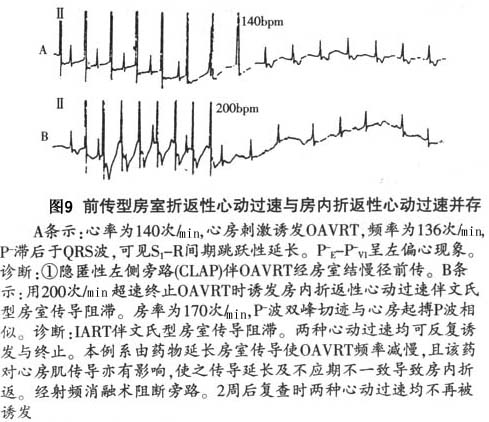 房室折返性心动过速检查