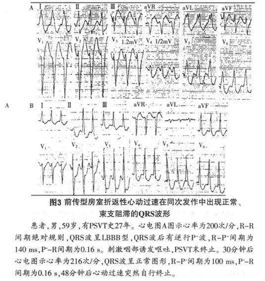 房室折返性心动过速