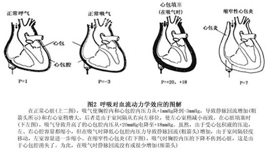 缩窄性心包炎