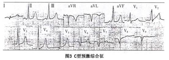 激综合征详细介绍  d9k1397y268n8vjwn1vmykhbqkknvhqm   在a型与b型