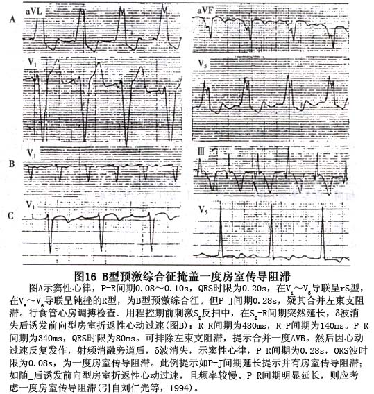 典型预激综合征