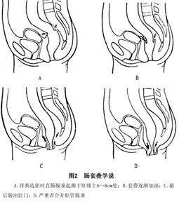 直肠脱垂