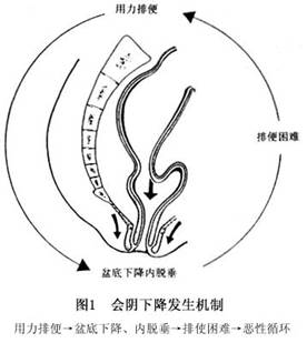 直肠脱垂