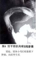 胃平滑肌肉瘤