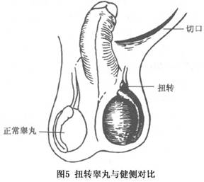 小儿睾丸扭转症状