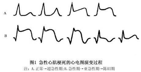 急性心肌梗死