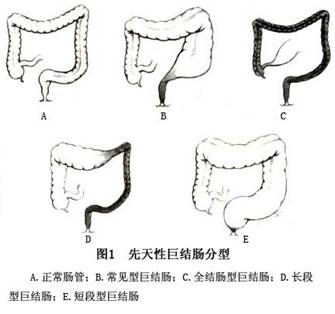 先天性巨结肠