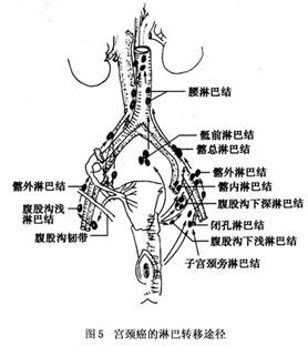 当癌瘤浸润到阴道下1/3或外阴时,沿淋巴走向转移到腹股沟淋巴结.