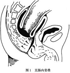 直肠内套叠