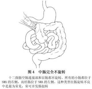 小儿肠旋转不良