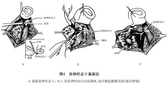 涎腺混合瘤