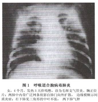 小儿呼吸道合胞病毒肺炎-大河健康网-+大河网