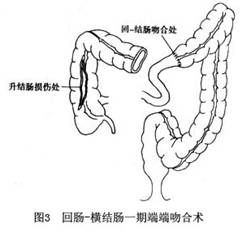 侧腹壁或后腰部有压痛
