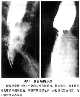 食管癌如何检查_疾病查询_阿里医药网