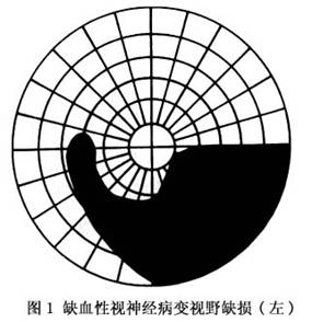 视野缺损_视野缺损的表现图片
