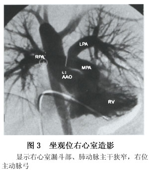 小儿法洛四联症检查