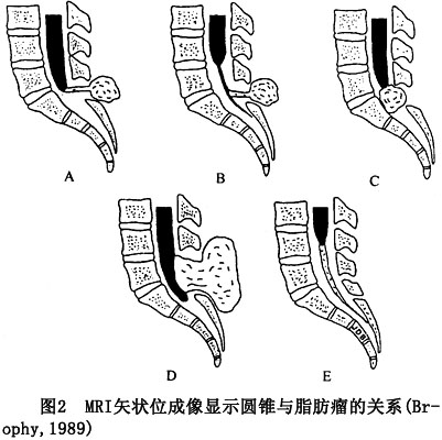 脊髓栓系综合征检查