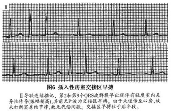 房室交接区性期前收缩
