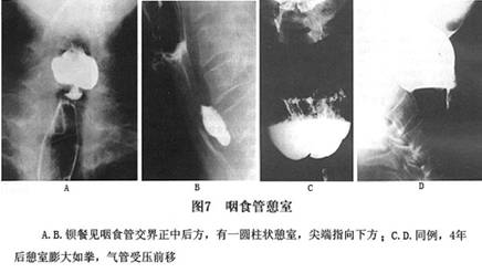 咽食管憩室检查