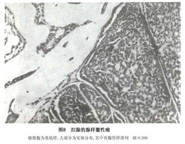 腺样囊性癌